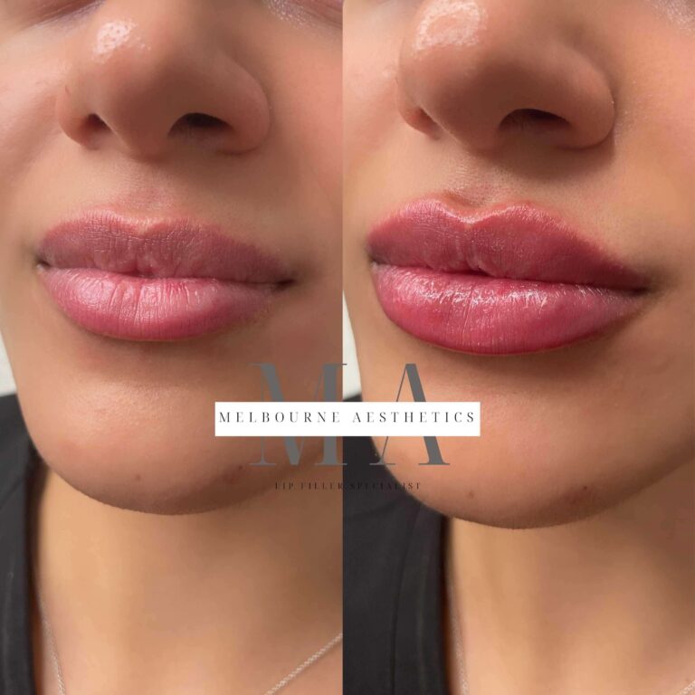 Melbourne Lip Filler service