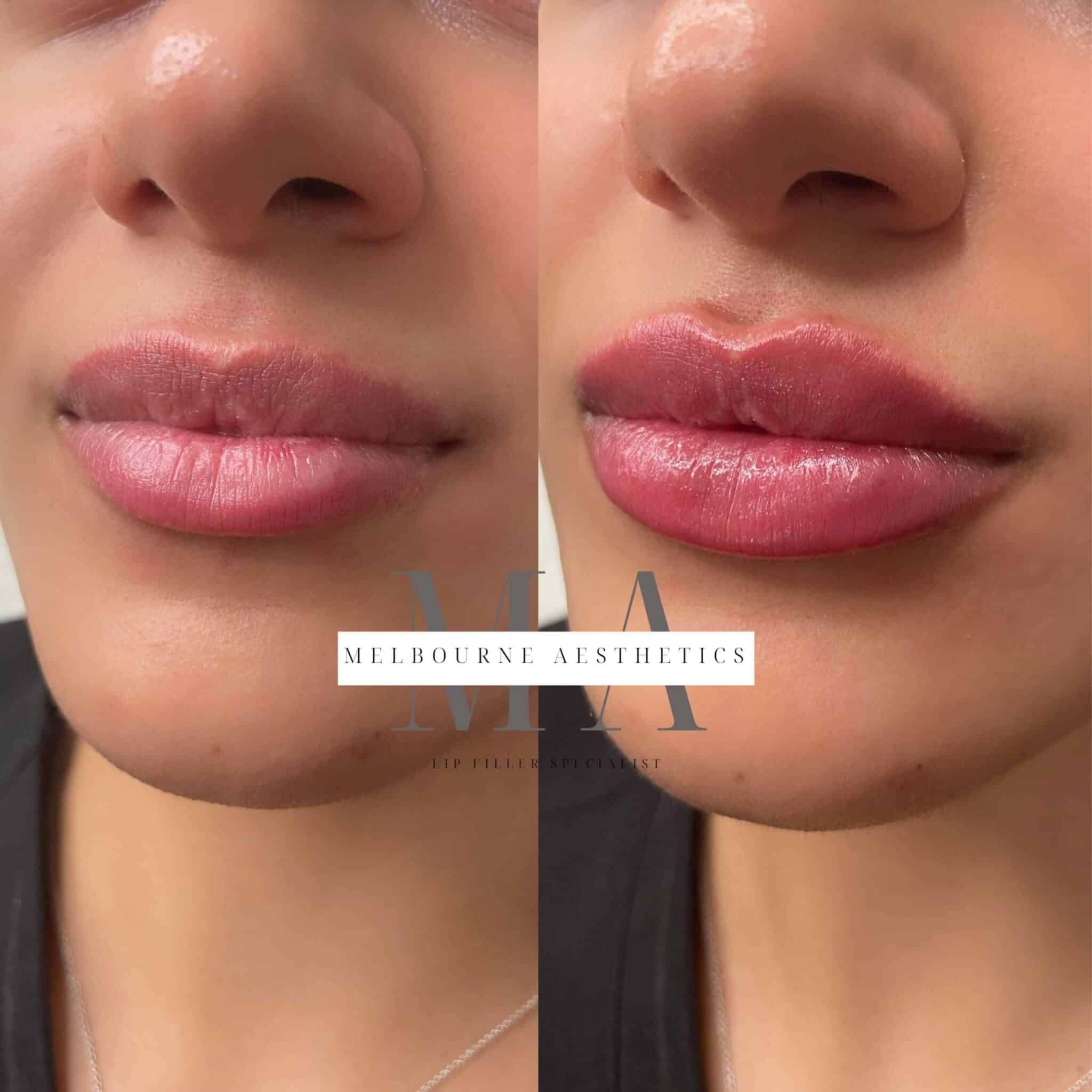 Lip Filler Melbourne Melbourne Aesthetics